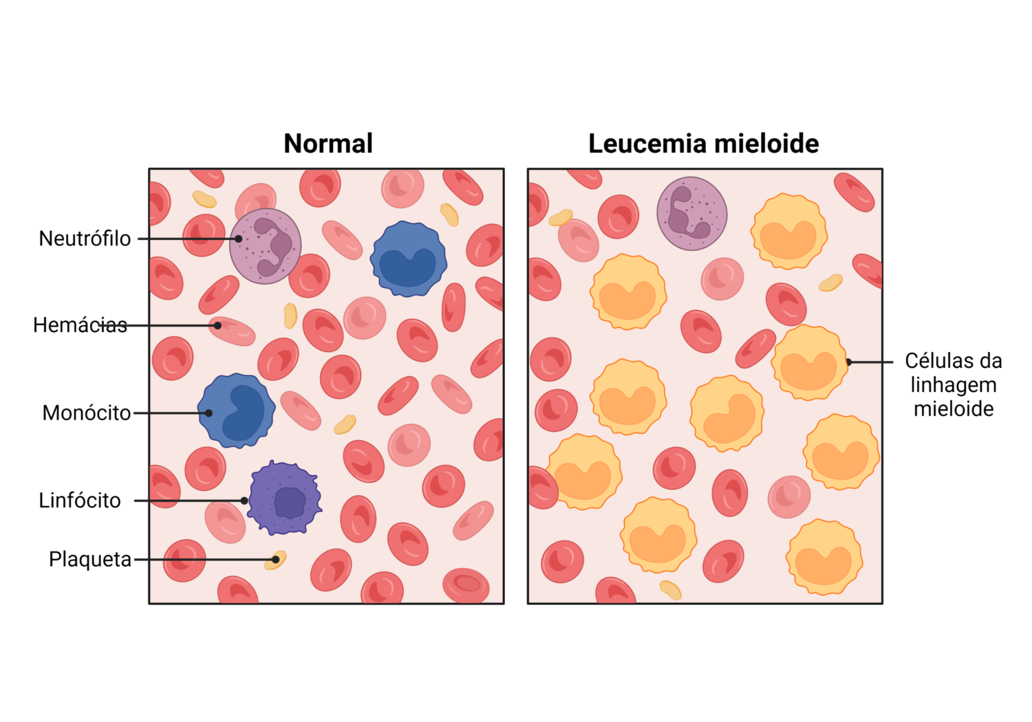 Quais São Os Tipos De Leucemia? - Cursau Educação - Blog