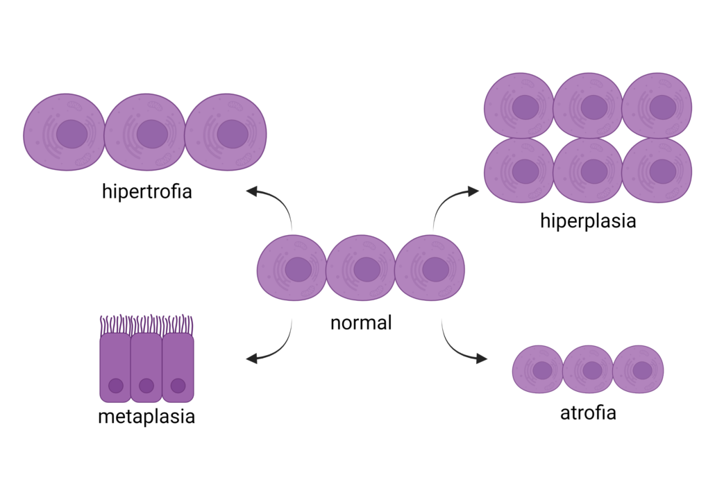 a imagem ilustra as adaptações celulares. Na hipertrofia acontece o aumento do tamanho da célula. Na hiperplasia acontece o aumento do número de células. Na atrofia as células diminuem de tamanho. Na metaplasia as células se diferenciam em outro tipo celular.